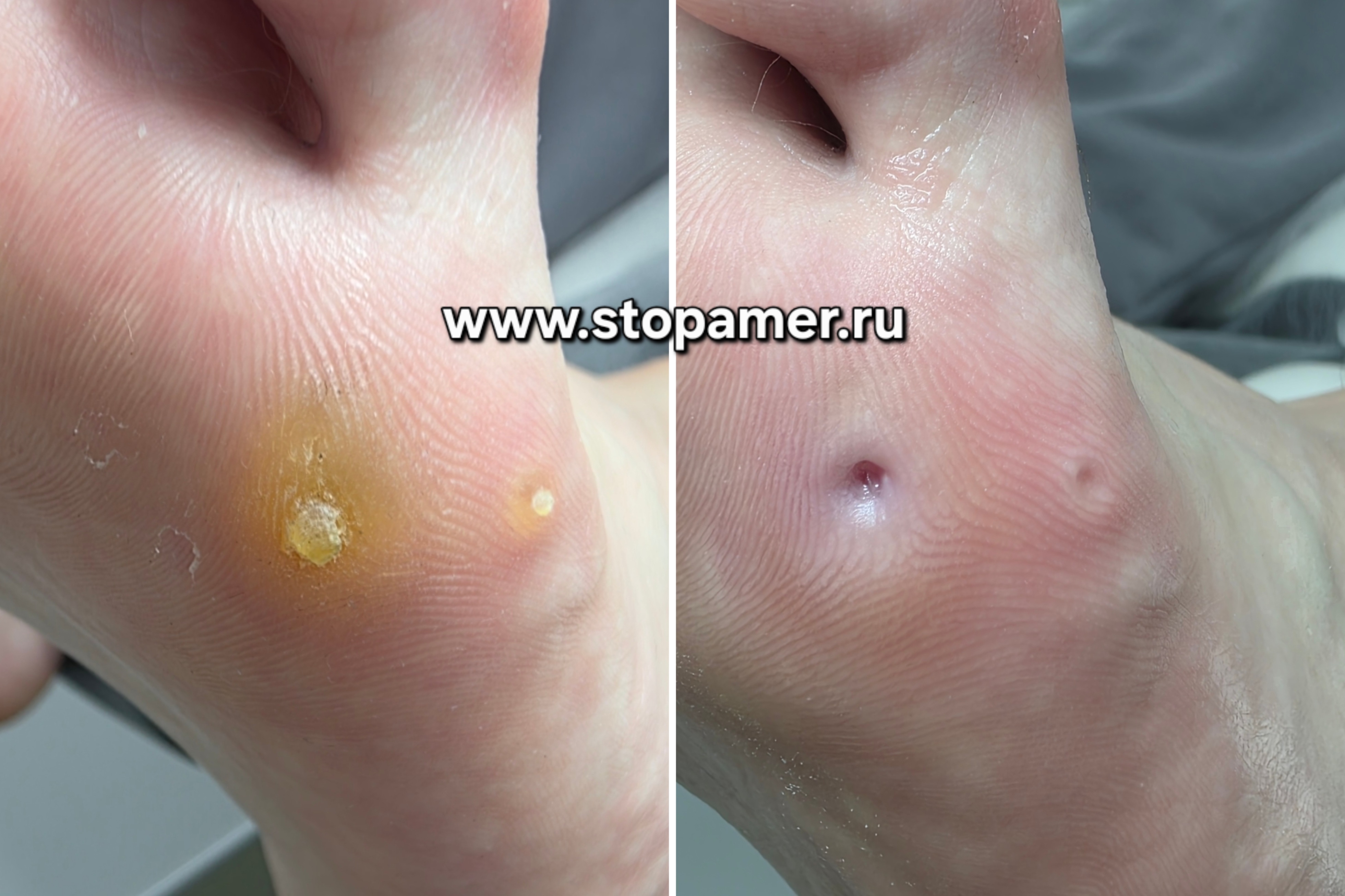 Стержневые мозоли 5 сустав
