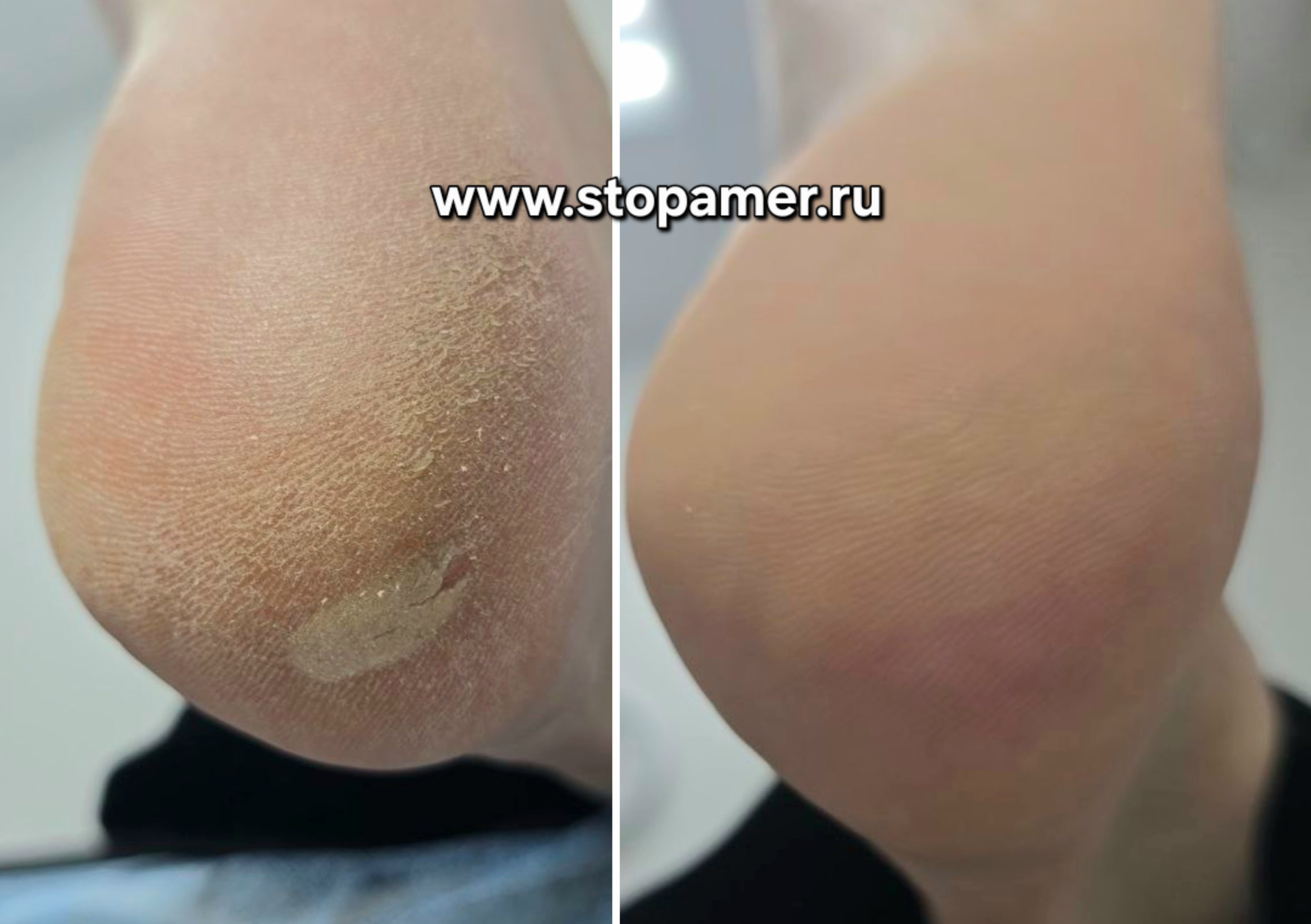 Сухая мозоль