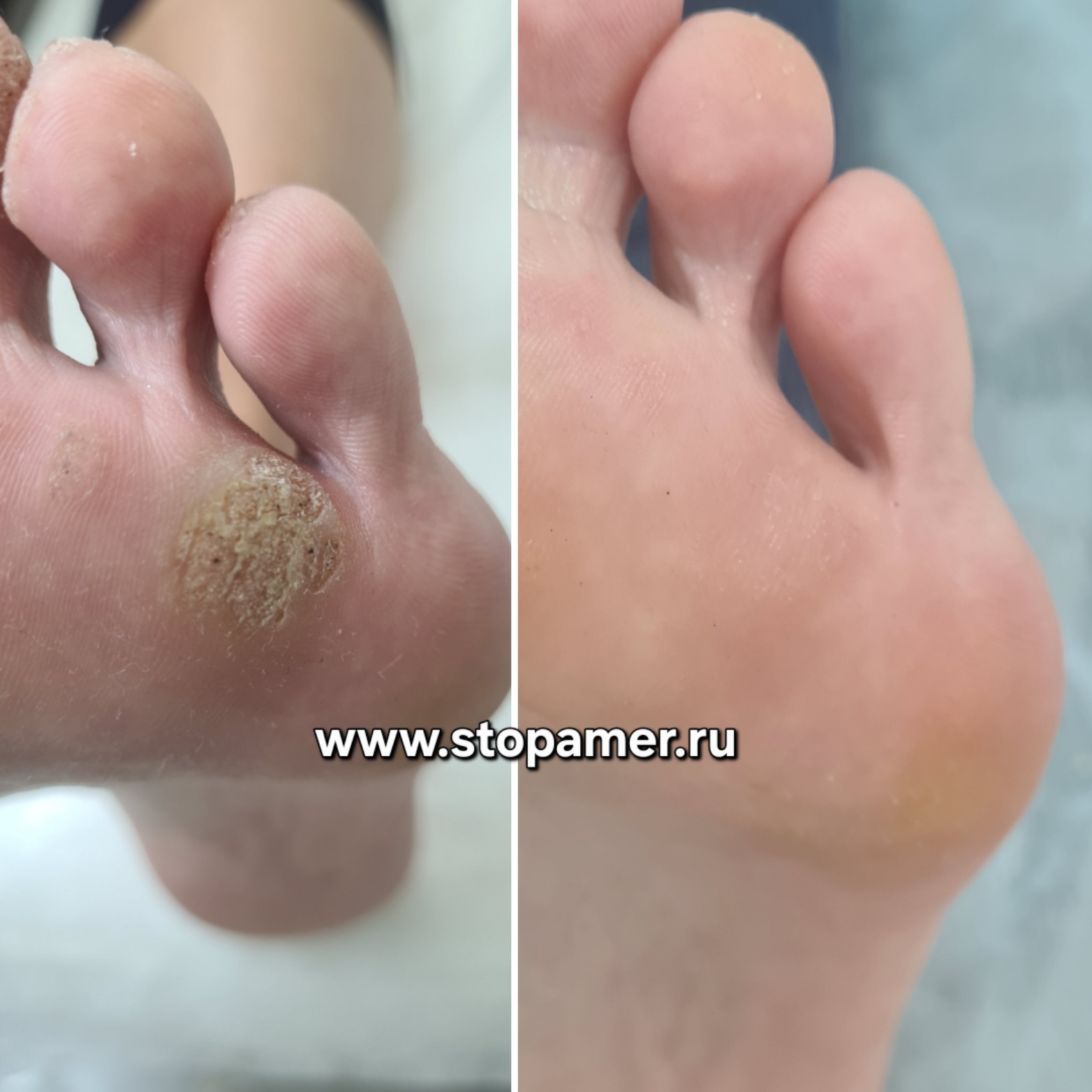 Бородавки Денисова