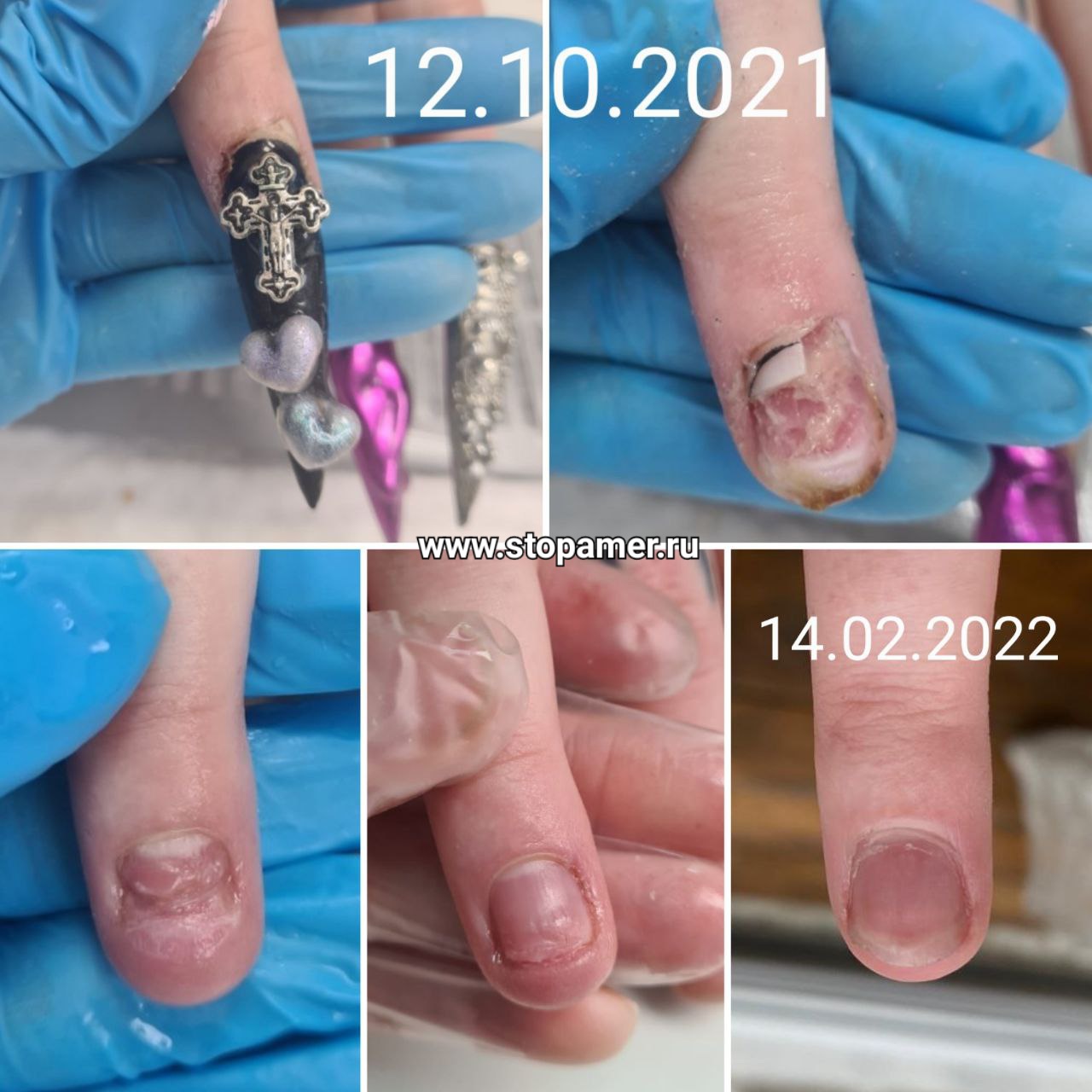 Травма на руках Денисова