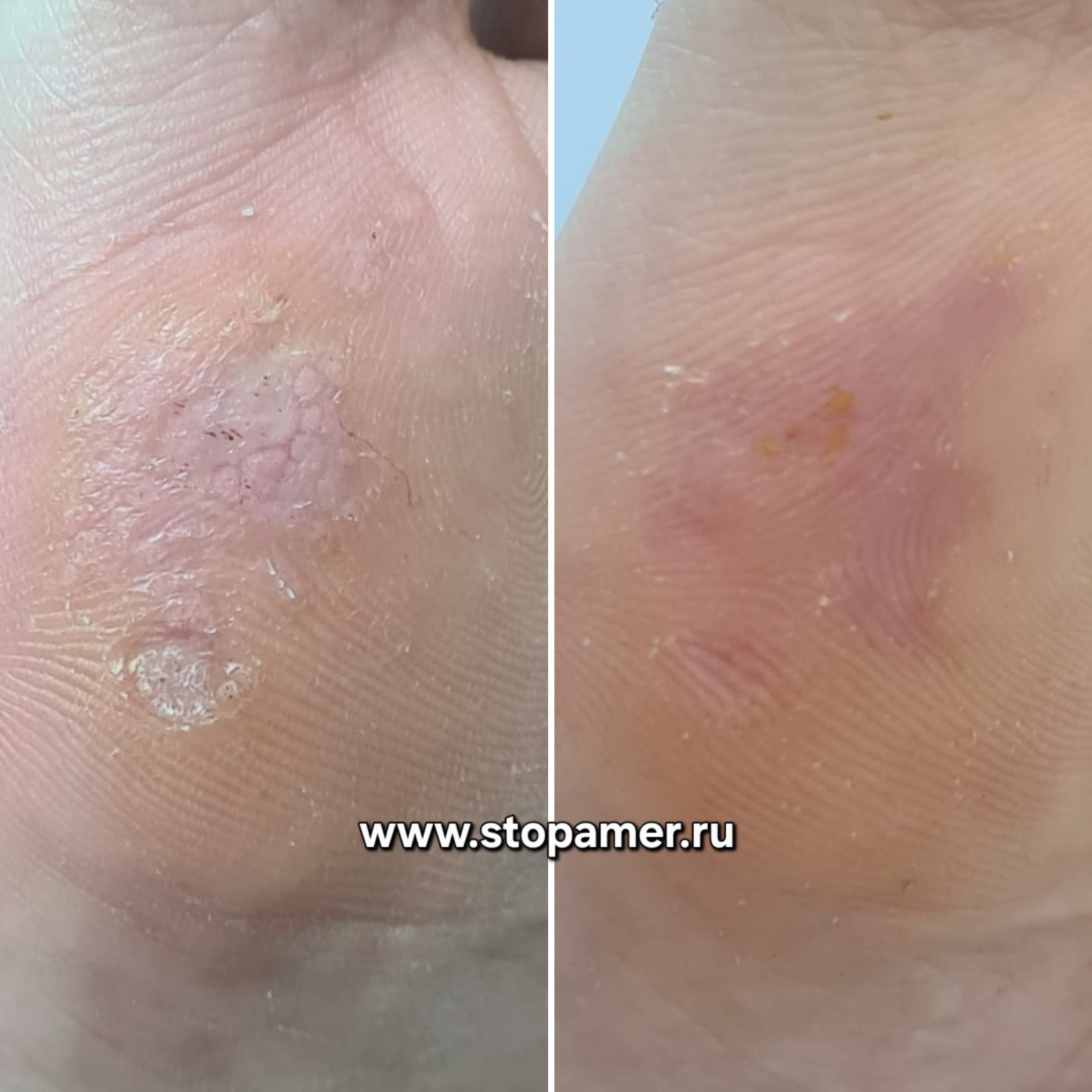 Бородавки плюсна Марина