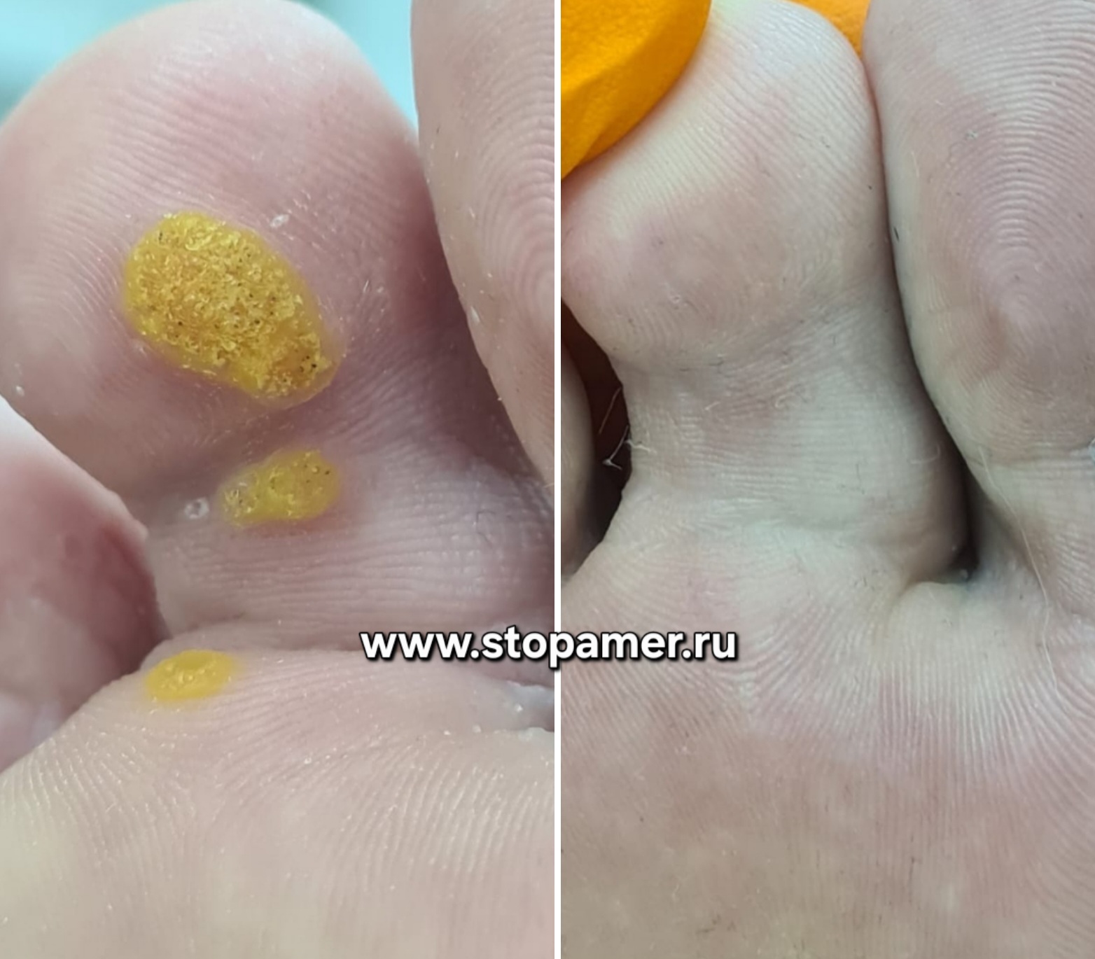 Бородавки пальцы Марина