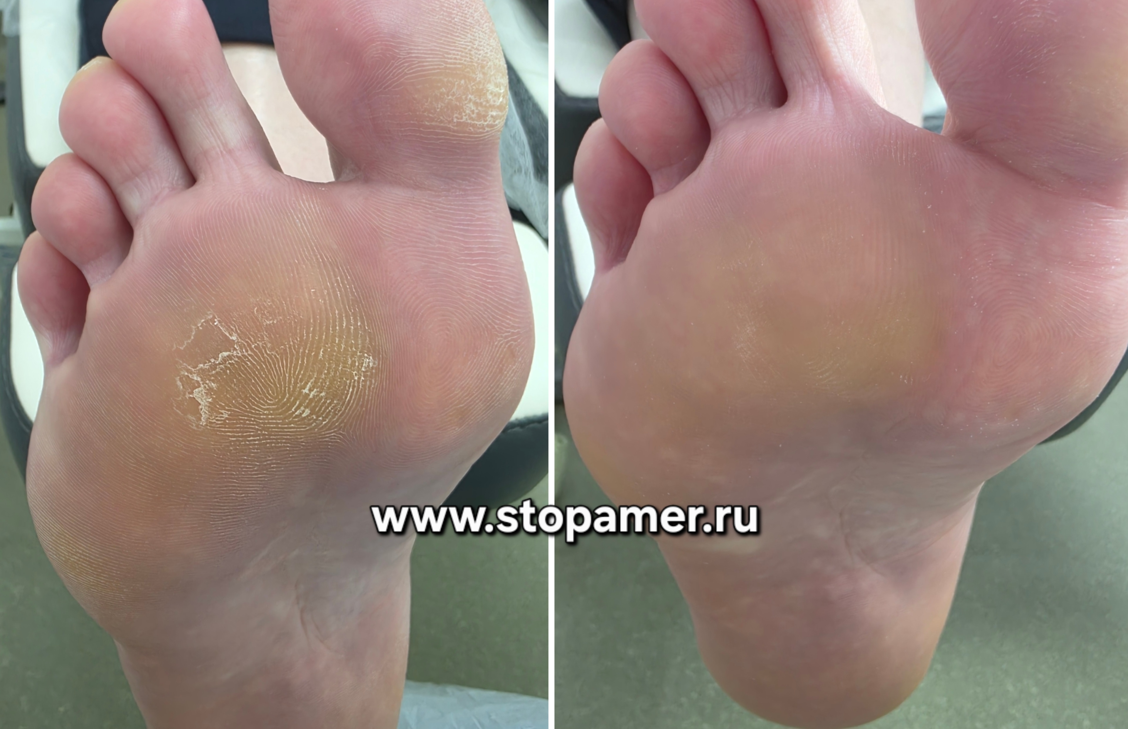 Сухая мозоль на плюсне Марина