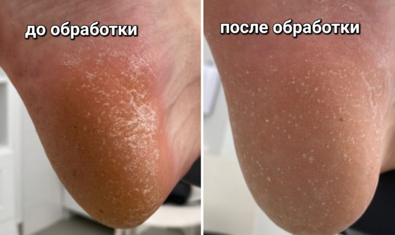 Гипергидроз стоп Гипергидроз стоп