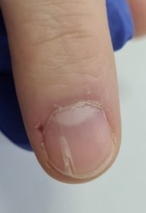 Онихорексис Онихорексис на руке