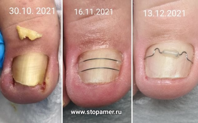 лечение вросшего ногтя методикой орнитоксии динамика фото