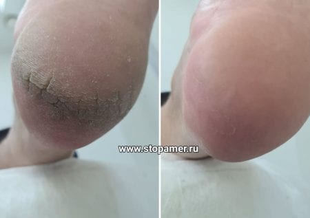 Обработка трещин на ногах фото динамика 6