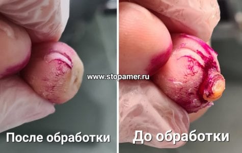 фото динамика удаление лечение стержневой мозоли