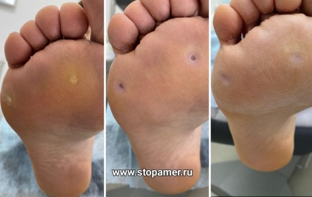 удаление безболезненная обработка стержневой мозоли фото динамика