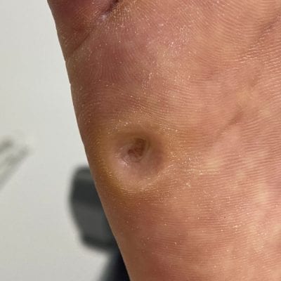 фото безболезненное удаление обработка сухой мозоли после